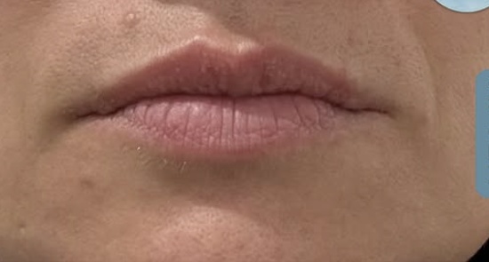 After lip flip treatment