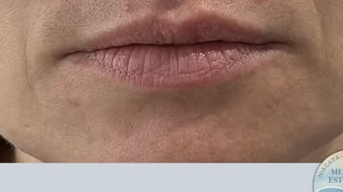 Before lip flip treatment