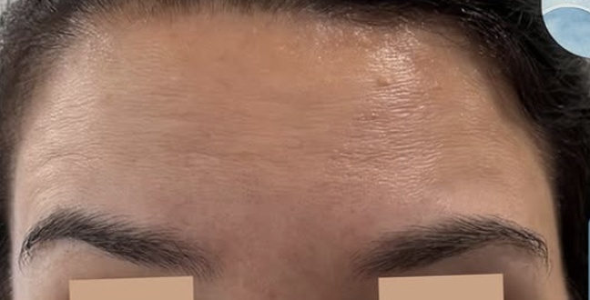 After wrinkle relaxer treatment for upper face