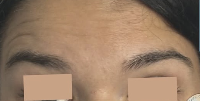 Before wrinkle relaxer treatment for upper face